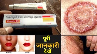 Clobenate Gm Cream Uses Or Side Effects in hindi [upl. by Ulla]