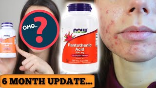 I TOOK PANTOTHENIC ACID FOR 6 MONTHS HERE IS THE UPDATE  Did B5 get rid of cystic acne fast [upl. by Past118]