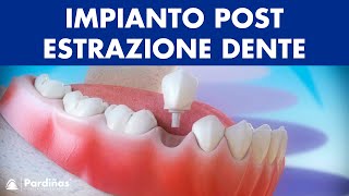 Impianto dentale immediato postestrazione dente © [upl. by Arodnahs]