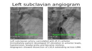 Left subclavian angiogram [upl. by Eikceb]