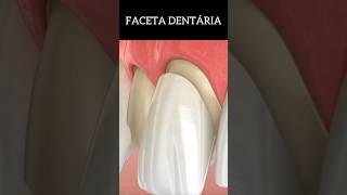 FACETA OU LENTE DENTÁRIA shortsfeed dentista odontodicas memes shortsvideo resumosdeodonto [upl. by Eleets]