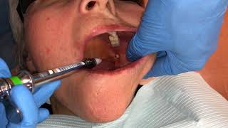 Inferior Alveolar and Lingual Nerve Blocks [upl. by Glovsky972]