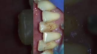 Scaling and Air Polishing using Prophymate teeth teethcleaning teethwhitening satisfying [upl. by Joelynn]