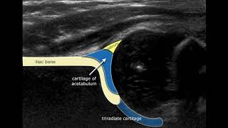 Congenital Hipdysplasia  Ultrasound Anatomy [upl. by Llevram]