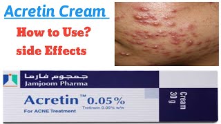 Acretin Cream  How to Use  Tretinoin  Acne Treatment [upl. by Grewitz]