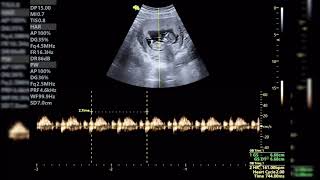 ECOGRAFÍA DE 11 SEMANAS DESCARTANDO PATOLOGIA CARDÍACA [upl. by Vyner]