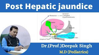 Post Hepatic jaundice  Obstructive jaundice  Deepak PD Singh [upl. by Aleahcim]