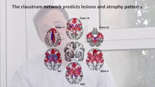 Localizing parkinsonism based on focal brain lesions [upl. by Eduard600]