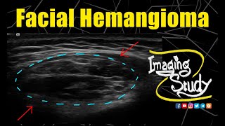 Facial Hemangioma  Doppler  Ultrasound  Case 259 [upl. by Aicekat]