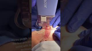 New Ellacor MicroCoring Treatment [upl. by Audres517]