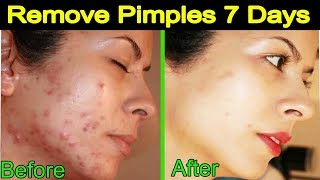 How to Remove Pimples and Dark Spots in just 7 days  100 Natural [upl. by Gaal]