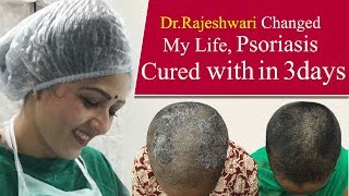 How To Cure Scalp Psoriasis Instantly  Dr Rajeshwaris Health Care [upl. by Hose]