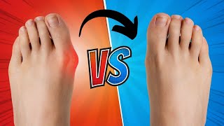 MinimallyInvasive Bunion Correction Surgery [upl. by Wivestad]