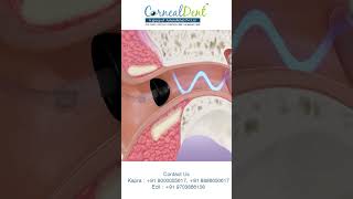 Hearing aid fixation  Cornealdent [upl. by Aloeda]