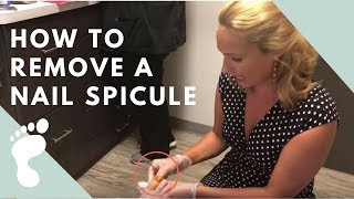 quotNAIL HORNquot Spicule Removal [upl. by Yenittirb]