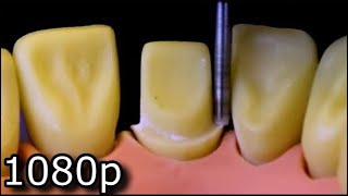 All Ceramic Crown Preparation For Upper Central Maxillary Incisor [upl. by Itsirk122]