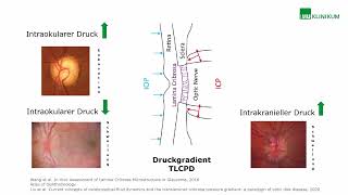 Vom Gehirn zum Auge oder umgekehrt – das Mysterium Normaldruckglaukom [upl. by Doloritas]