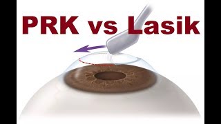 PRK VS Lasik Hindi [upl. by Kauppi]