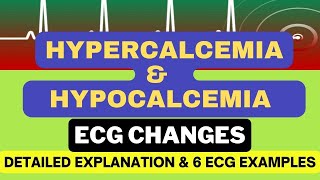 Hypercalcemia and Hypocalcemia ECG changes with 6 Examples Mechanism and Detailed Explanation [upl. by Nyltiac]