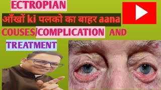 Ectropian couses and treatment आँखों ki नीचे ki पलक का बाहर aanaectropian क्या होता है [upl. by Oinotnas]