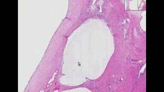 Histopathology Soft tissue dorsal wristGanglion [upl. by Cira87]