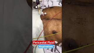 Pericardial Fluid Aspiration🩷 [upl. by Nosyt]