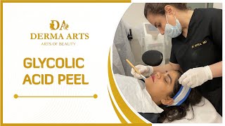 Glycolic Acid Peel by Dr Mitra Amiri  Chemical Peel Treatment at Derma Arts Clinic [upl. by Mairim]