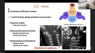 ASSI Webinar on Odontoid Fractures [upl. by Ordnagela]