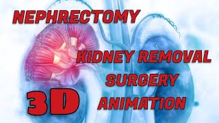 Nephrectomy Kidney Removal Surgery 3d animation in english nephrectomy kidney surgeryanimation [upl. by Nohsyt]