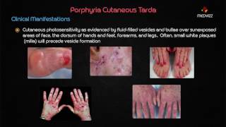 Porphyria cutanea tarda PCT  Biochemistry usmle step 1 webinar lecture [upl. by Ecyt934]