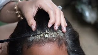 Dry scalp and lice removal technique 🤮🤮🤮🤮🤮🤮🤮🤮🤮🤮🤮🤮🤮🤮🤮🤢🤢🤢🤢🫢🫢🫢🫢🫢 [upl. by Hentrich]