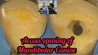 Access opening of Mandibular Canine step by step demonstration rct for beginners dental lectures [upl. by Refinne]