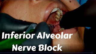 Inferior Alveolar nerve Block Injection in dentistry Landmark amp Technique in Dental Teeth Surgery [upl. by Llerrehs613]