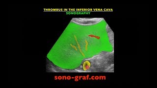 Sonography  Thrombus in the inferior vena cava [upl. by Saunders]