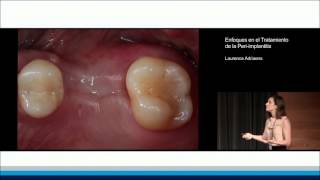 Enfoques en el Tratamiento de la Periimplantitis  Laurence Adriaens [upl. by Vaas990]