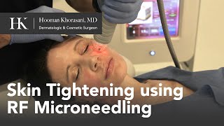 Skin Tightening of the Face using RadioFrequency RF Microneedling by Dr Hooman Khorasani [upl. by Eyla]