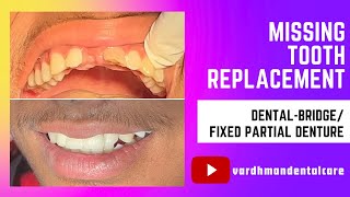 Replacing A Missing Tooth DentalBridge vardhmandentalcare [upl. by Aja638]