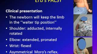 Obstetric Brachial Plexus Palsy OBPP Erbs Palsy [upl. by Ramirolg470]