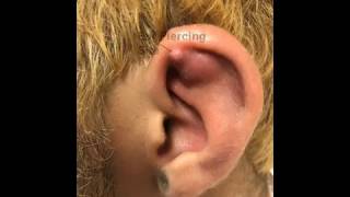 Left Ear Helix Abscess Chondritis or Not [upl. by Kajdan197]