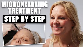 The Ultimate Microneedling Facial For Flawless Skin  Microneeedling Treatment Stepby Step [upl. by Gurias971]