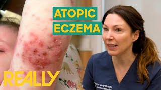 Toddler With Severe Form Of Eczema Visits Dr Emma  The Bad Skin Clinic [upl. by Carmelo36]