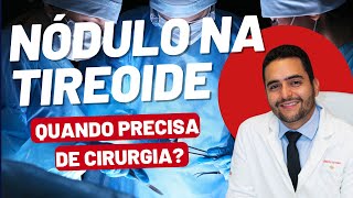 Nódulos na Tireoide Quando precisa de cirurgia [upl. by Adiell406]