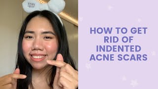 How To Get Rid of Indented Scars  FaceTory [upl. by Auoh]