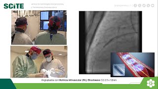 Litotricia intravascular en reestenosis intrastent por marcada infraexpansión [upl. by Lon]