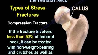 Stress Fractures Of The Femoral Neck  Everything You Need To Know  Dr Nabil Ebraheim [upl. by Honan]