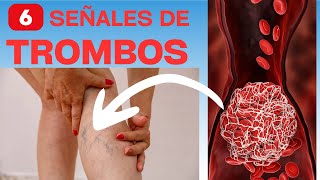 6 señales de que tendrás trombosis o coágulos [upl. by Trini]