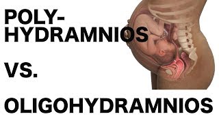 Polyhydramnios vs Oligohydramnios [upl. by Relda]