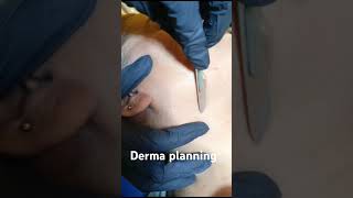 derma planning [upl. by Westbrooke]