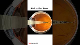 What is Refractive Error 👀  shorts [upl. by Oiramal502]