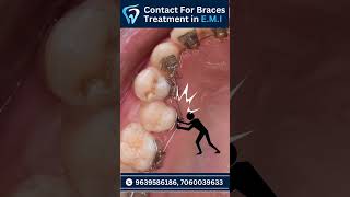 Braces Treatment Timepass  dentist toothdental facts dentalclinic doctor [upl. by Mattland]